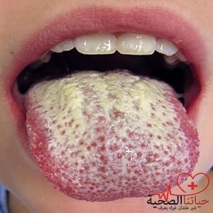 علاج فطريات الفم عند الاطفال بالاعشاب