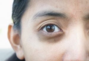 علاج الهالات السوداء تحت العين طبيا