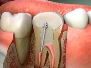 علاج وجع عصب الاسنان