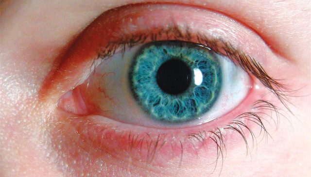 مرض المياة الزرقاء في العين فطحل