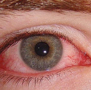 مرض المياة الزرقاء في العين فطحل